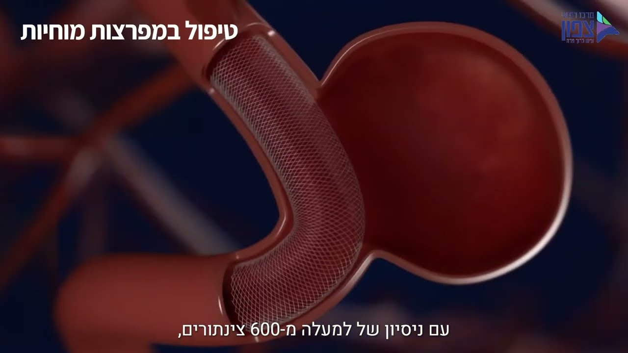צנתורי מוח במרכז רפואי צפון