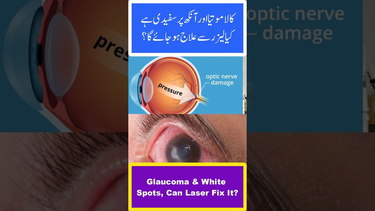 Kala Motia | Glaucoma & White Spots, Can Laser Fix It?