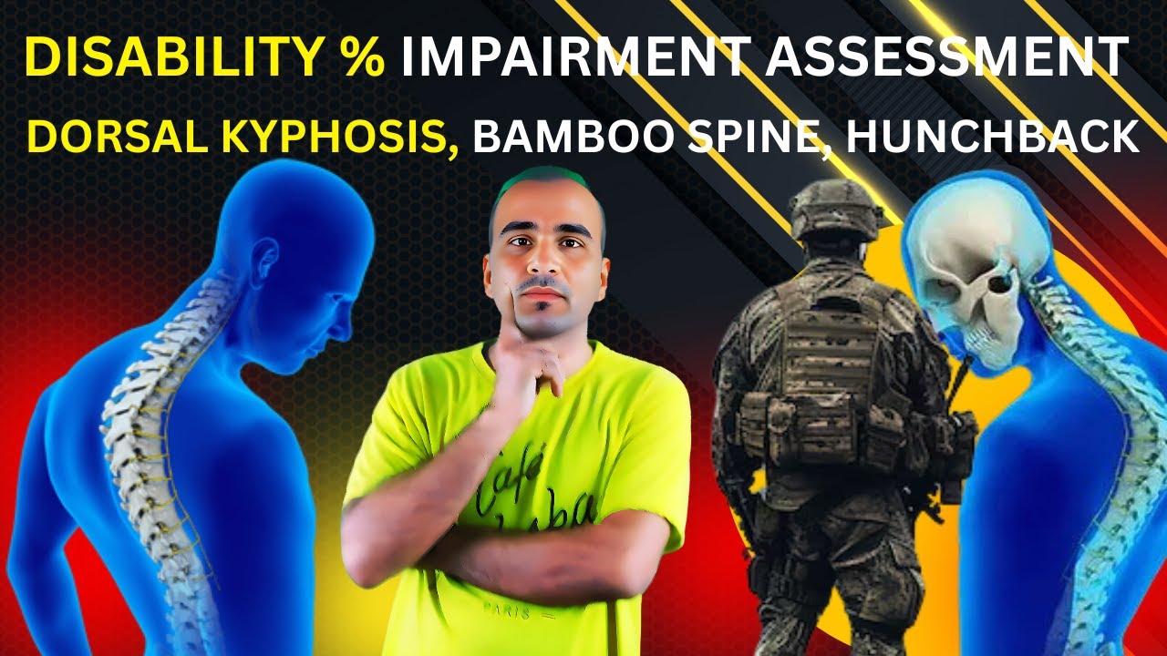 Can Indian Soldiers with HUNCHBACK, Bamboo Spine or Dorsal Kyphosis Get Disability Benefits?