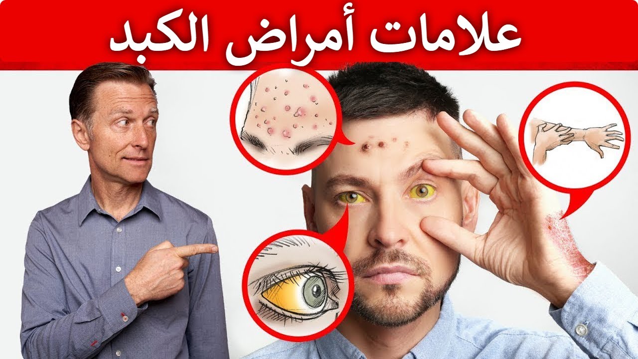 ١٥ علامة في الجلد تخبركم عن أمراض الكبد وماهو أفضل طعام للكبد