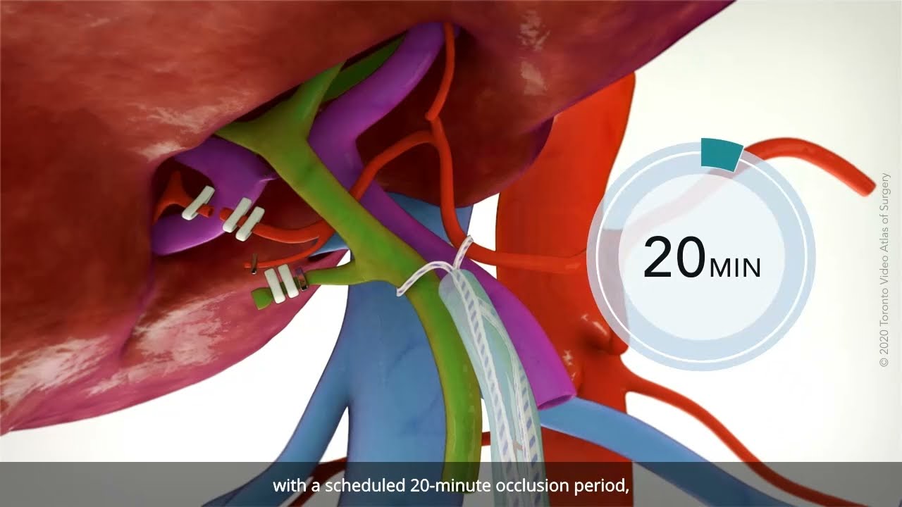 Laparoscopic right hepatectomy