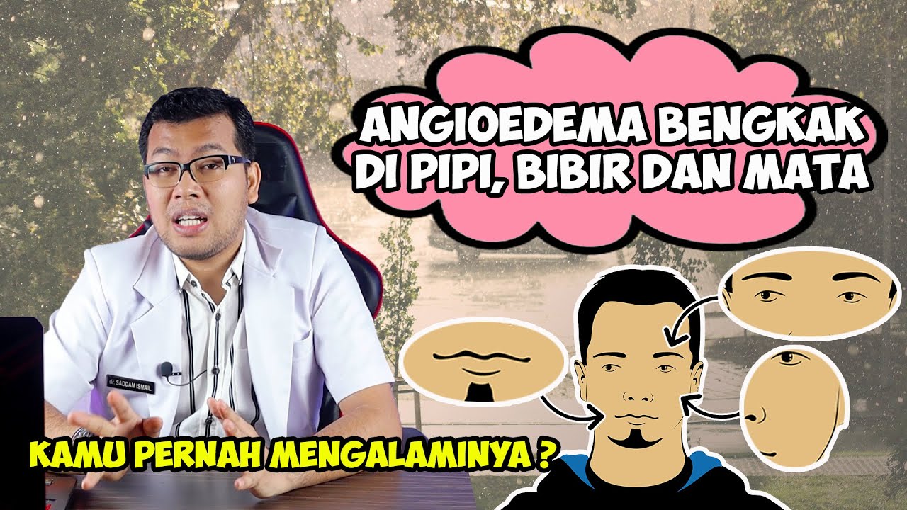 ANGIOEDEMA BENGKAK PADA PIPI BIBIR DAN MATA KARENA ALERGI - DOKTER SADDAM ISMAIL