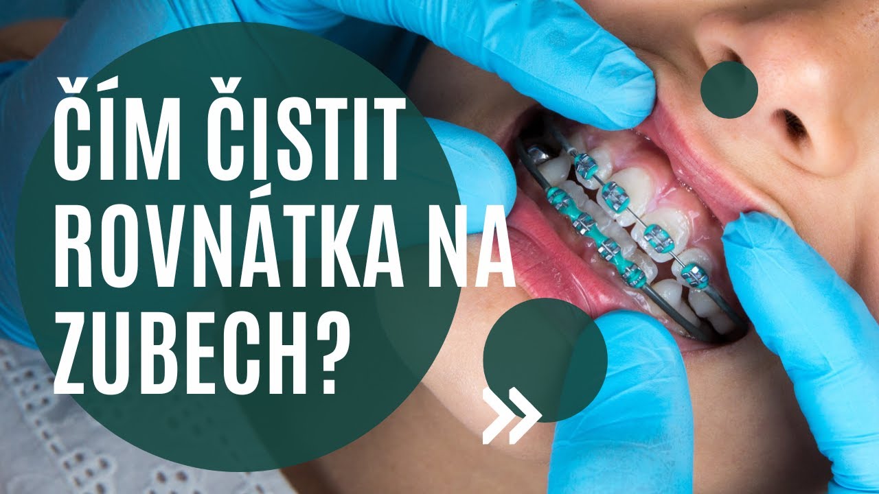 👐 Jaké všechny pomůcky používat k čištění rovnátek, aby nevznikly zubní kazy? 🫣