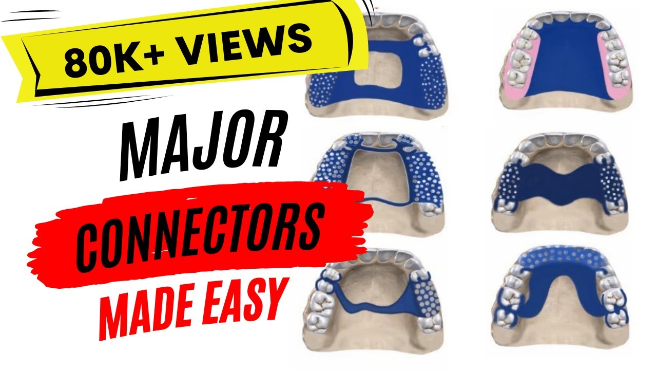Maxillary major connectors | Prosthodontics |