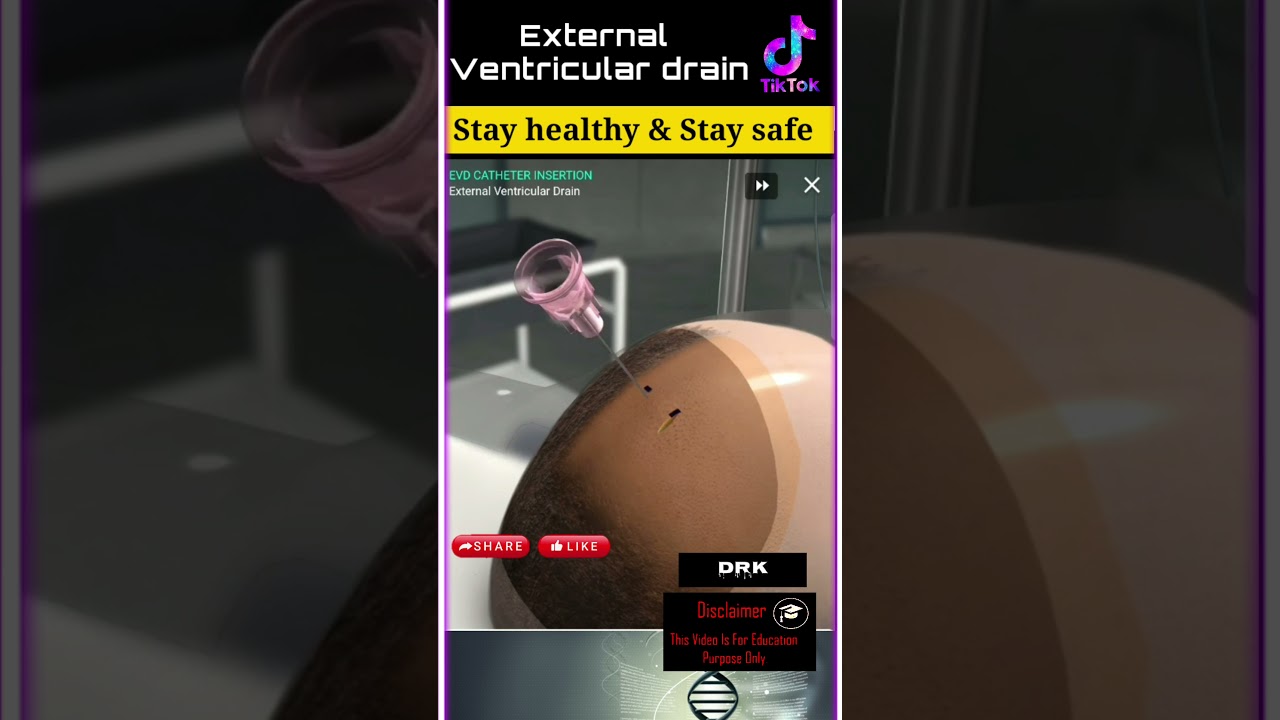 External ventricular drain