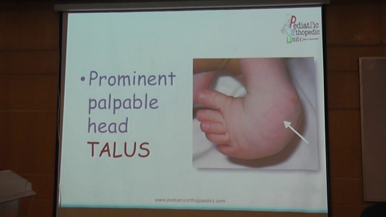 Club foot part 1