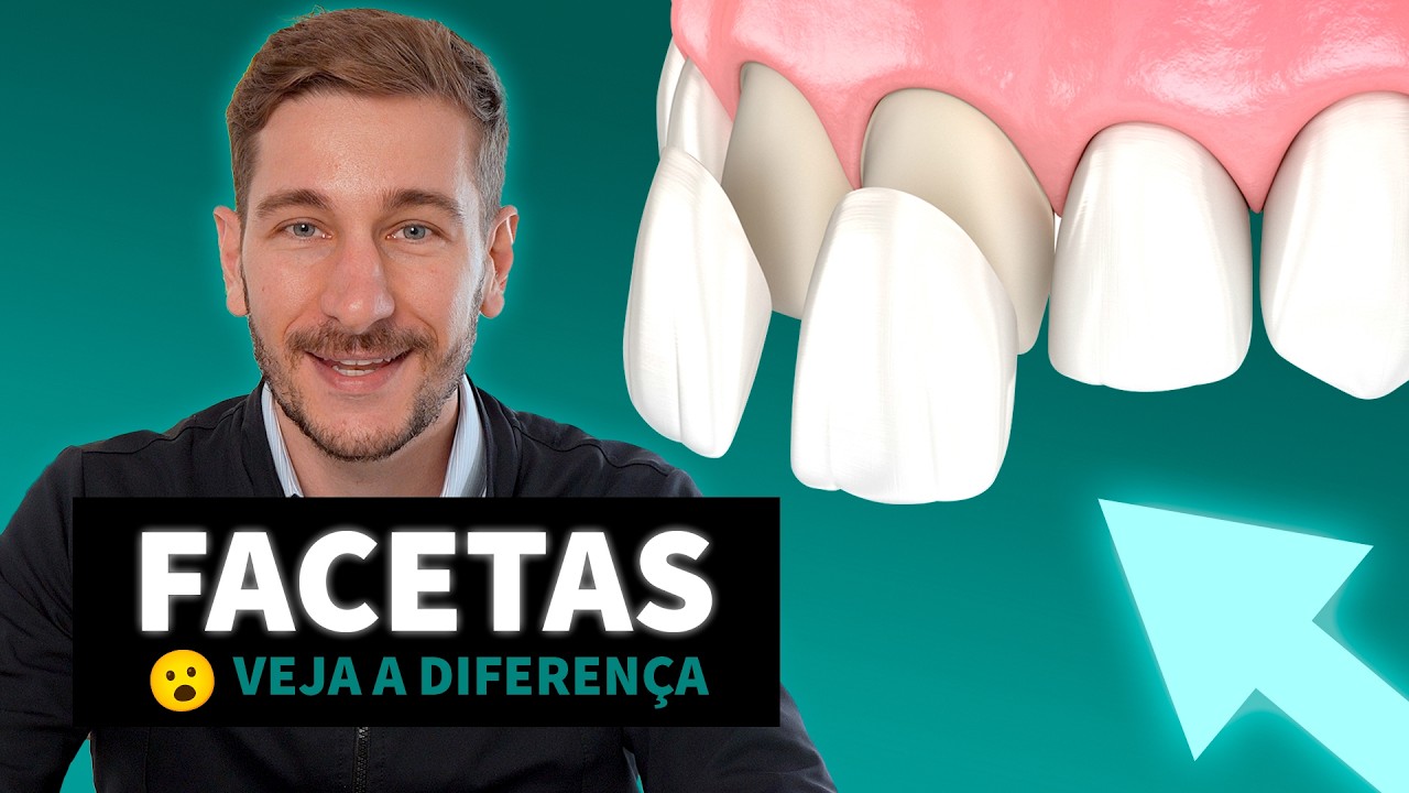 Facetas e Lentes de Contato Dental: Valem a Pena? Descubra o que ninguém te contou!