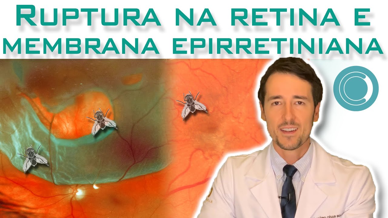 Mosca volante e rasgo na retina causam membrana epirretiniana?