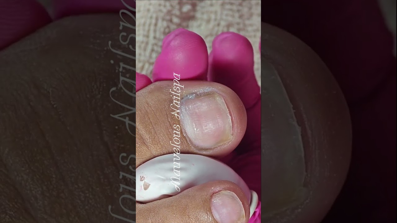 Full video pedicure with ingrown removal 