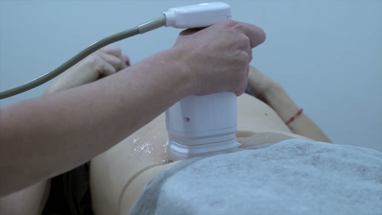 Liposonix en Abdomen en Sevilla