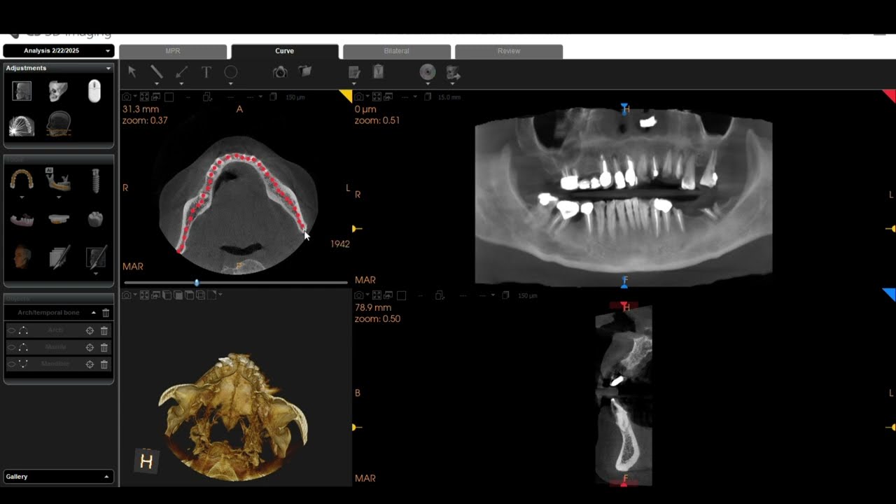 3D CBCT Nerve Canal Tracing .. How to trace a Nerve canal ?  Carestream Dental Software