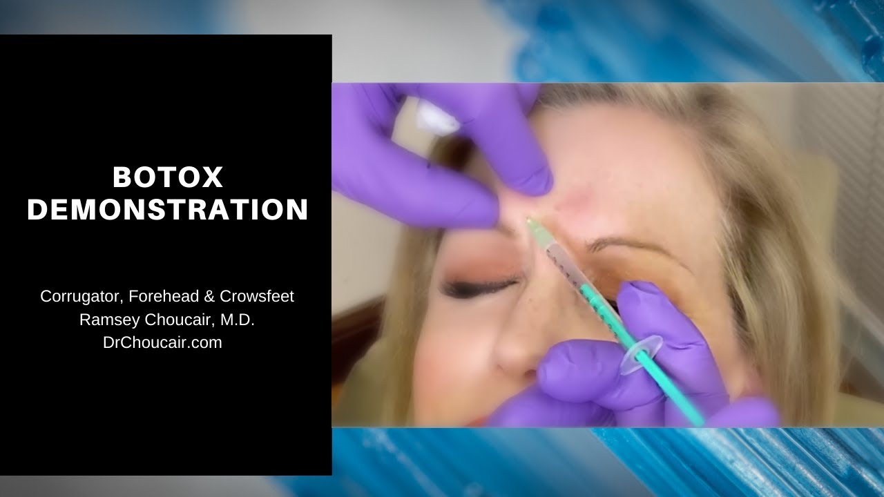 Botox® Demonstration: Corrugators, Forehead & Crowsfeet | Ramsey Choucair, MD. | Ph: 214-389-9797
