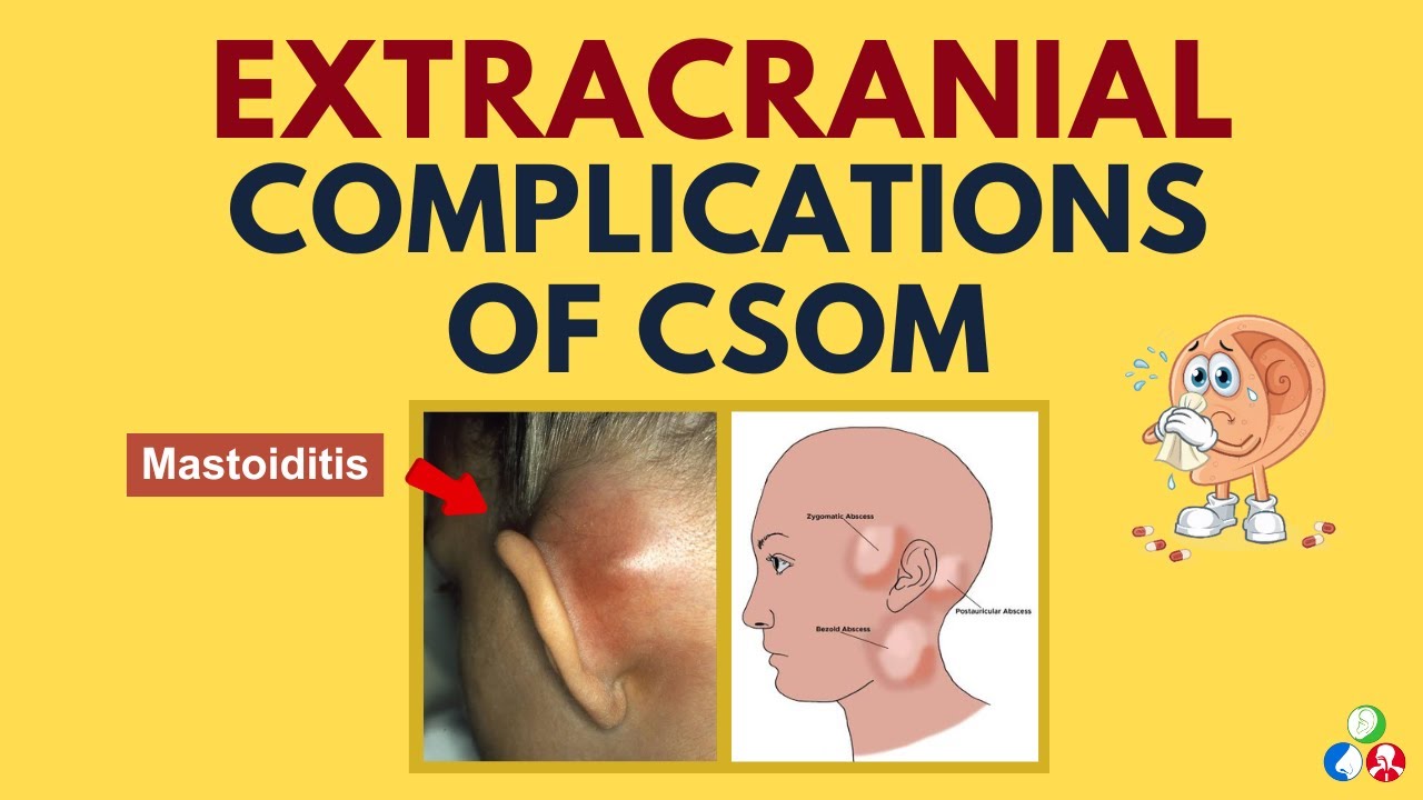 Extracranial Complications of Chronic Suppurative Otitis Media (CSOM) | Part 2
