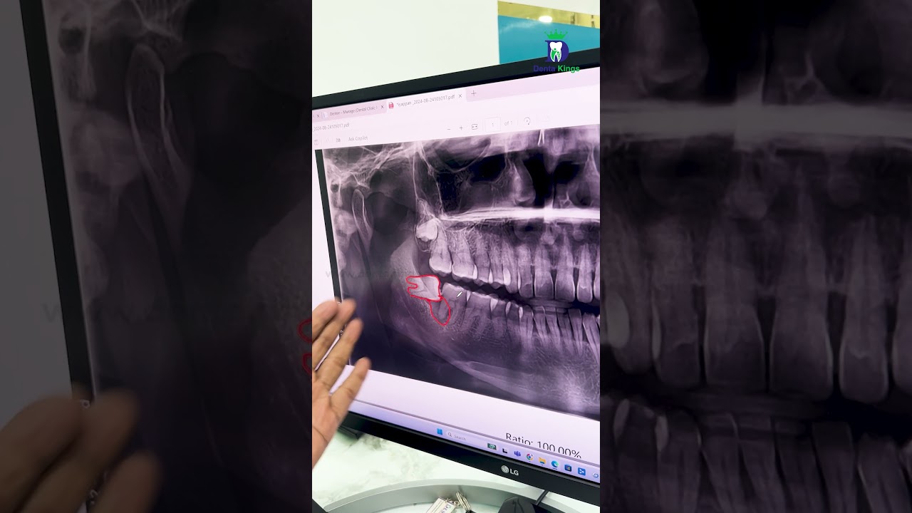 வலிக்காத ஞானப் பல்லையும் எடுத்து விடுங்கள்! - Preventive Extraction of Wisdom Tooth! | Denta Kings