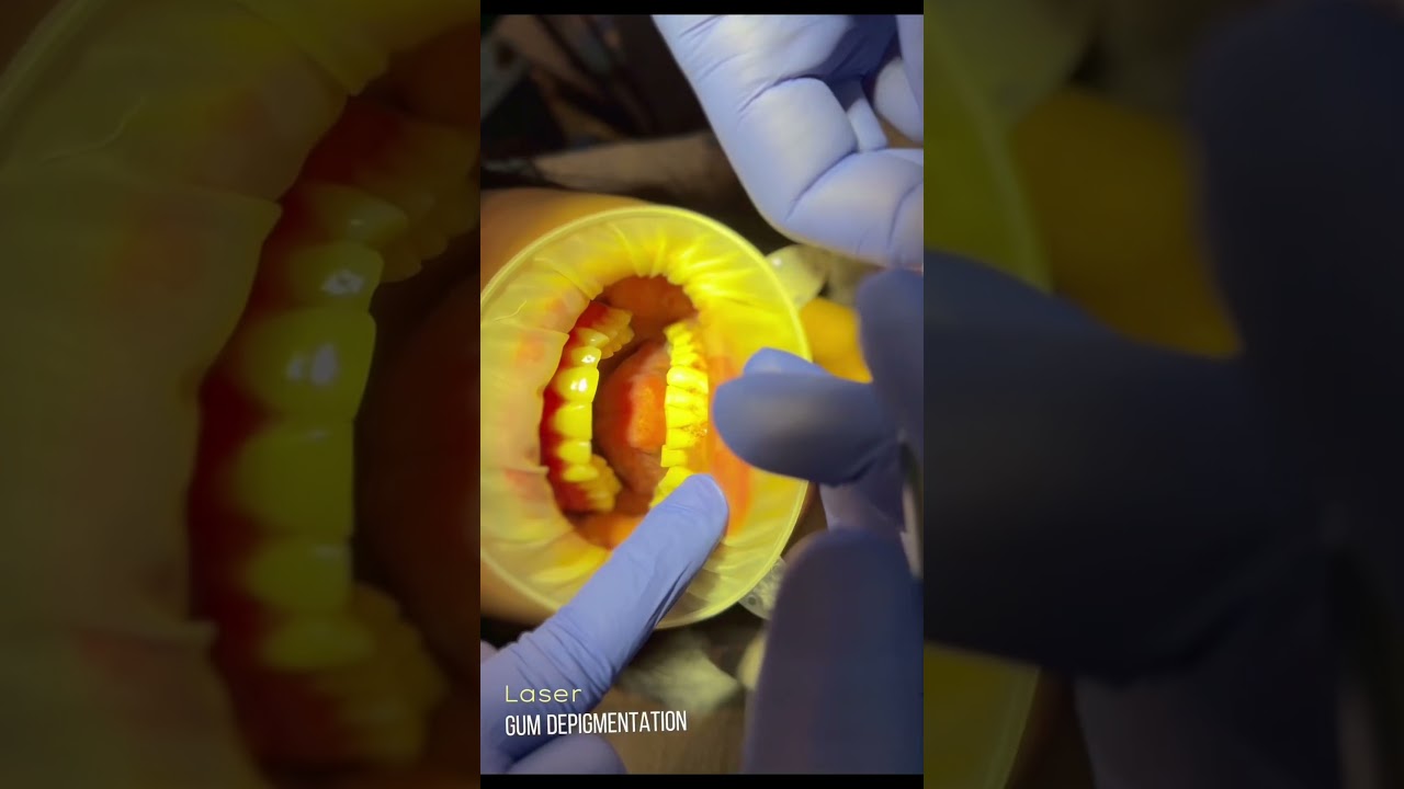 Laser Gum Depigmentation | 0177-0000007 | 01787-660055