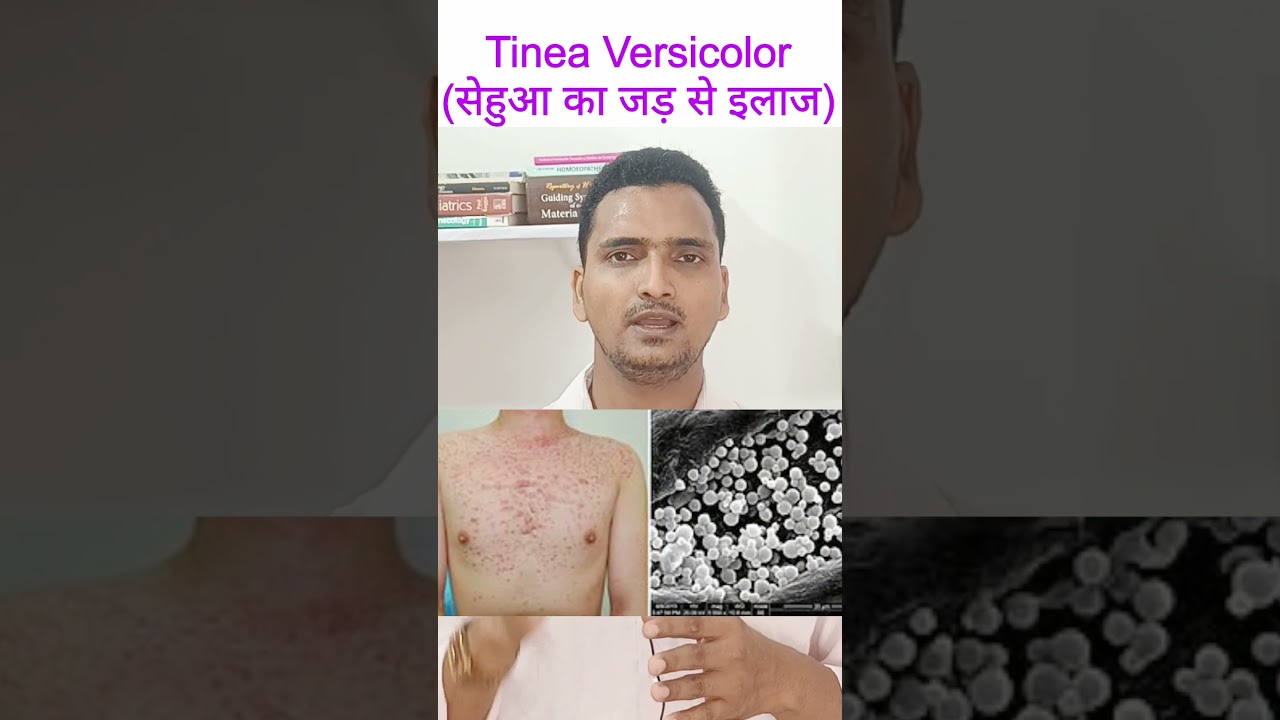 सेहुआ ka ilaj in hindi | Tinea Versicolar ka 100% Treatment | sehua ko kaise thik kare | white spots