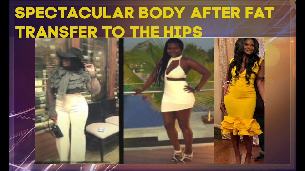 Feels Beautiful With Her Spectacular Body After Hourglass Hips Procedure | Dr. Cortes