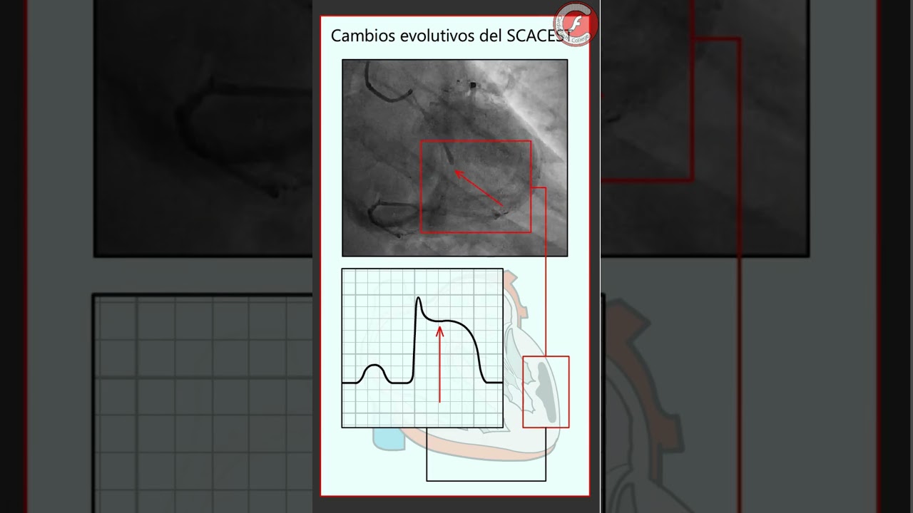 ECG 33 - Cambios evolutivos del ECG en SCACEST