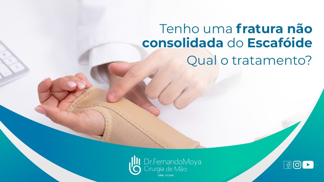 Tenho uma fratura não consolidada do Escafóide. Qual o tratamento? | Dr. Fernando Moya CRM 112046