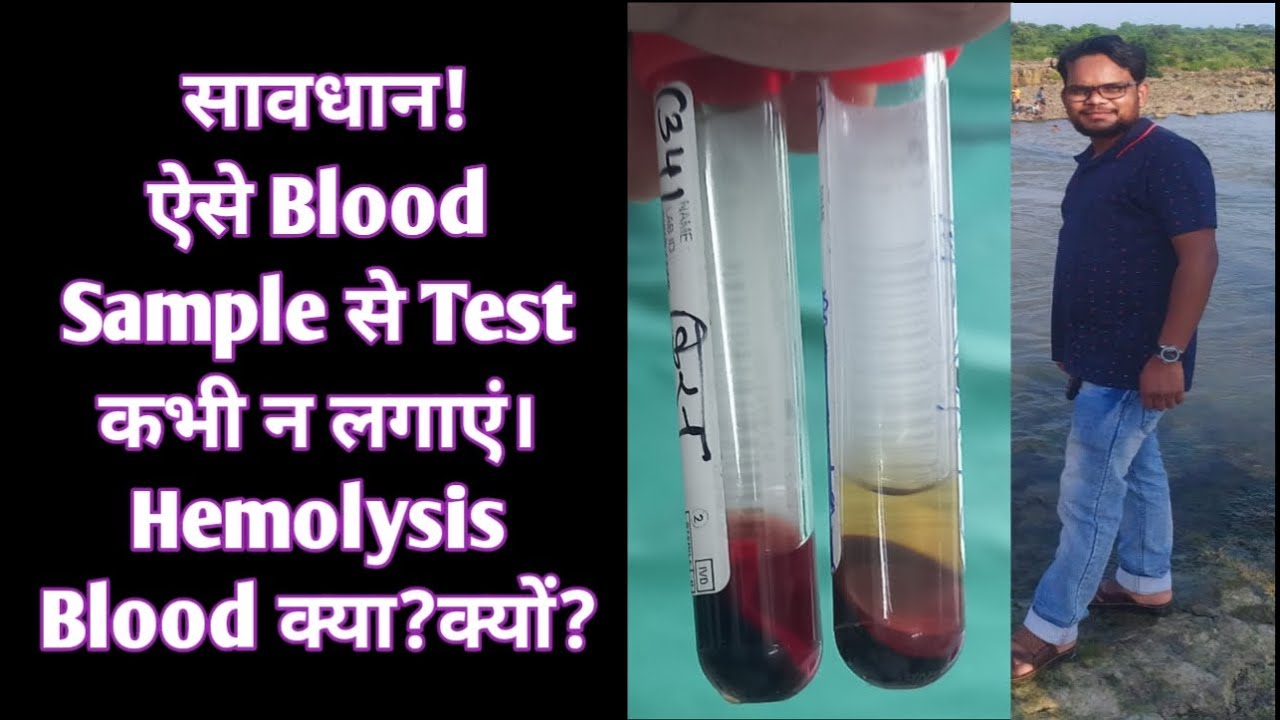 Hemolysis Blood क्या है?क्यों होता है? | Hemolyzed Blood से Test क्यों नही लगाए?