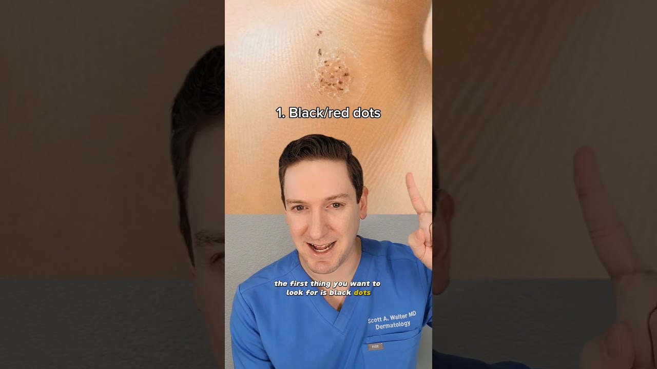 Dermatologist explains how to tell if you have a wart! #wart #verruca #whatsonmyskin #plantarwart