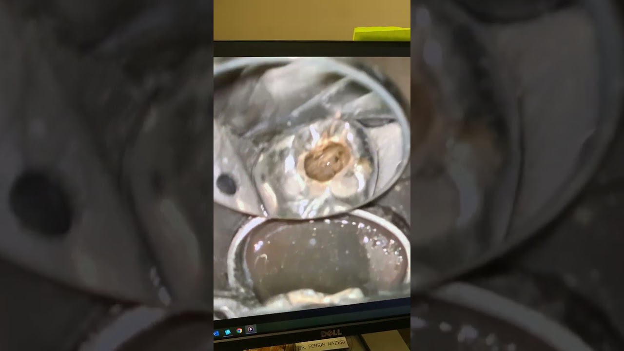 Zumax 2380 R2 POV of endodontic retreatment of tooth #3. Maxillary sinus perforation repair.