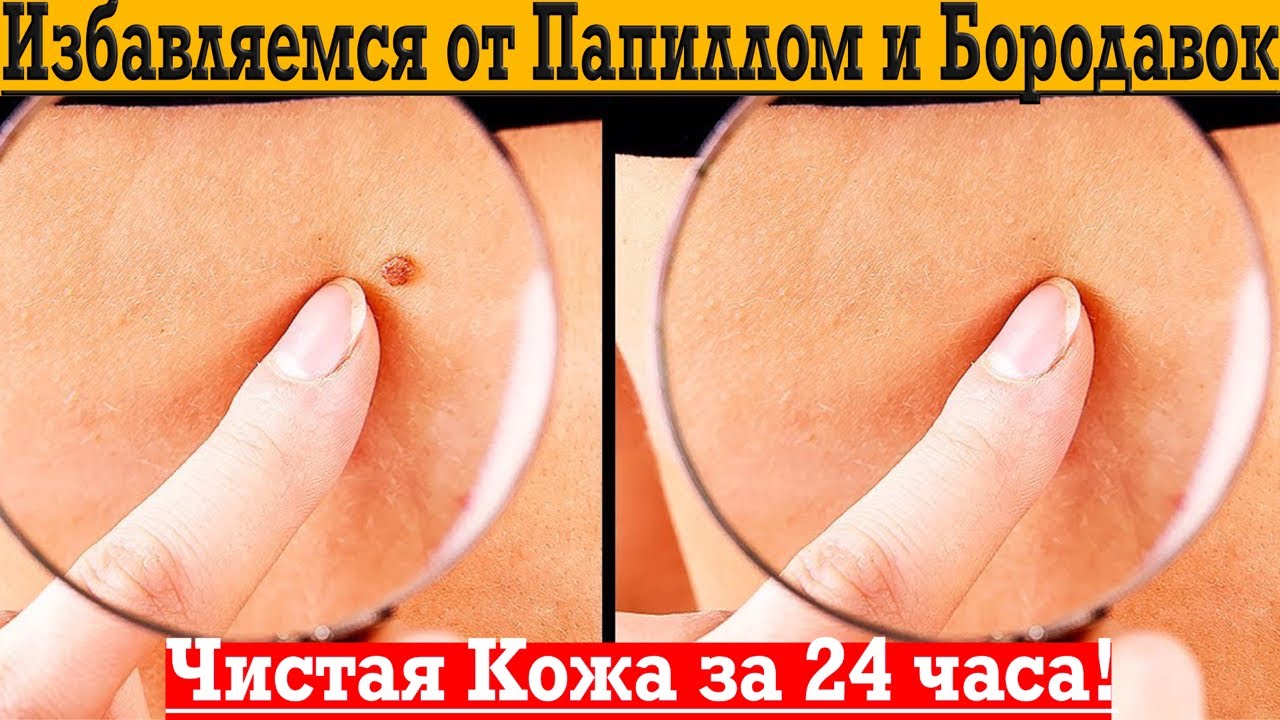 Избавляемся от папиллом и бородавок всего за 24 часа!