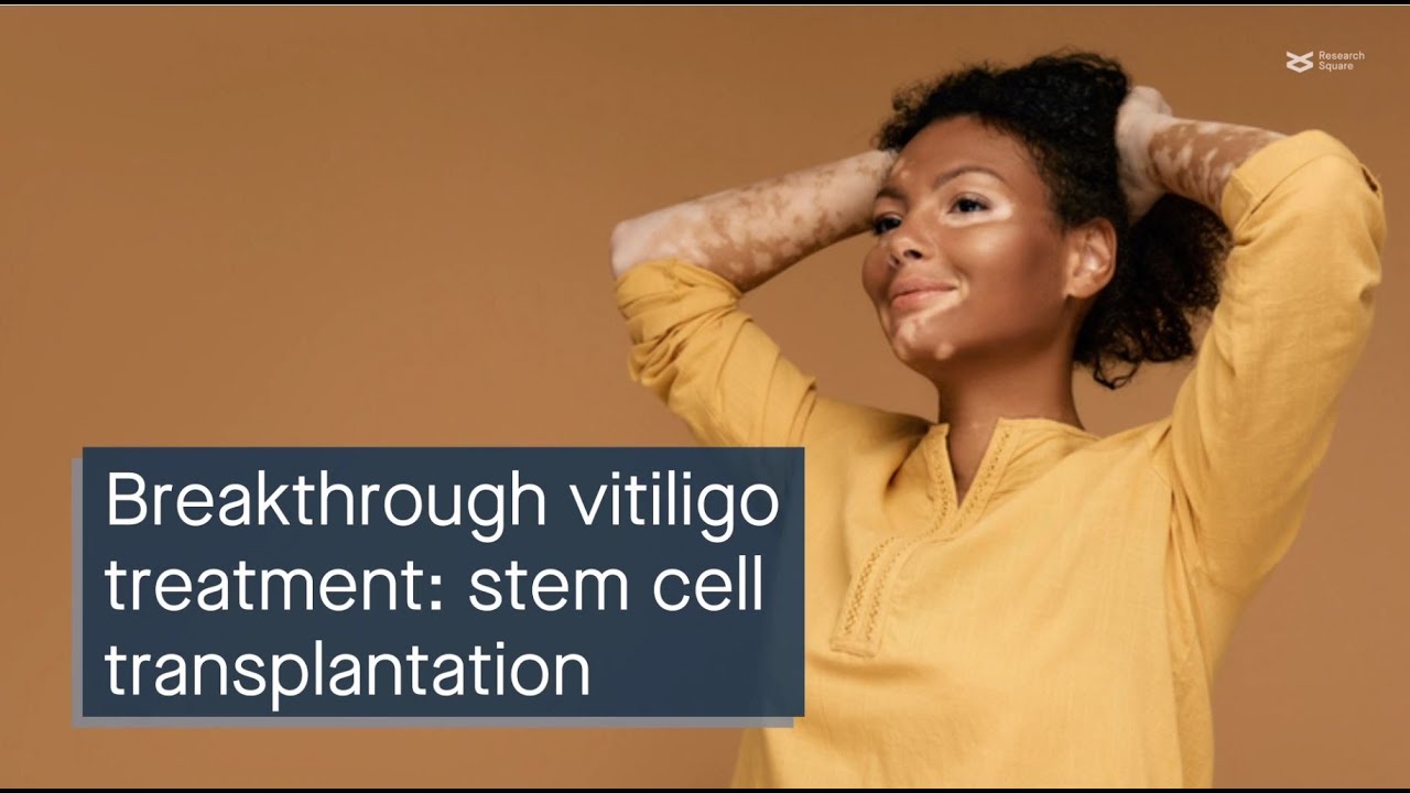 Breakthrough vitiligo treatment: hair follicle melanocyte stem cell transplantation