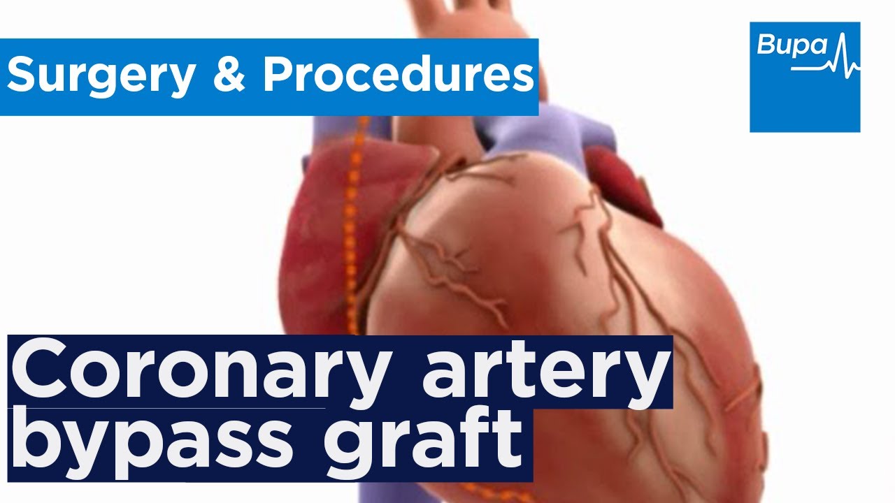 How coronary artery bypass graft (CABG) surgery is carried out | Bupa Health