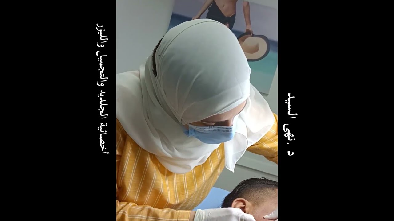 جلسة تقطيع ندبات حب الشباب
