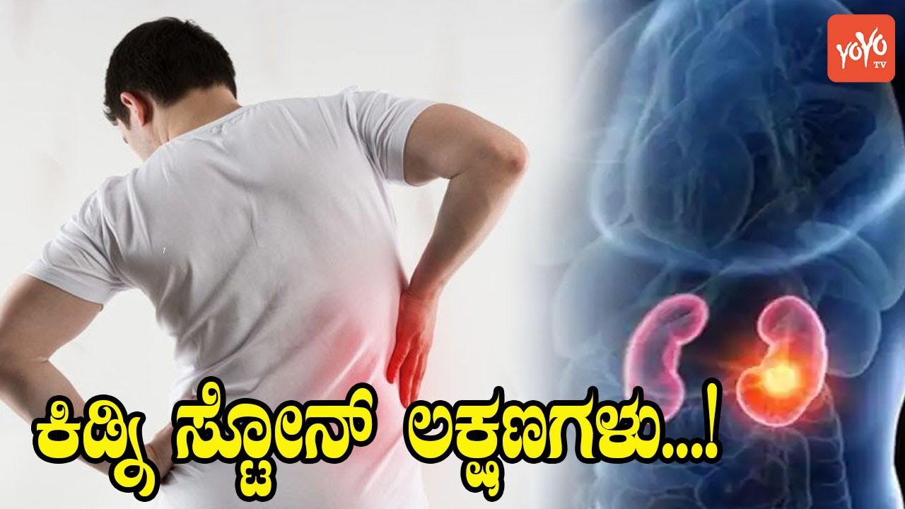 ಕಿಡ್ನಿ ಸ್ಟೋನ್ ಲಕ್ಷಣಗಳು&hellip; | Kidney Stone Symptoms in Kannada | YOYO Kannada News