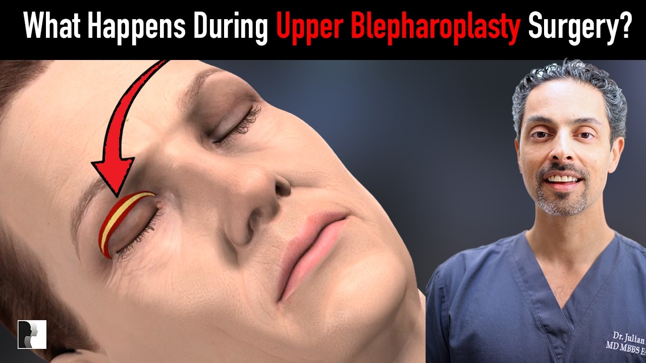 What Really Happens During Upper Blepharoplasty Surgery? - 3D Animation Explanation!