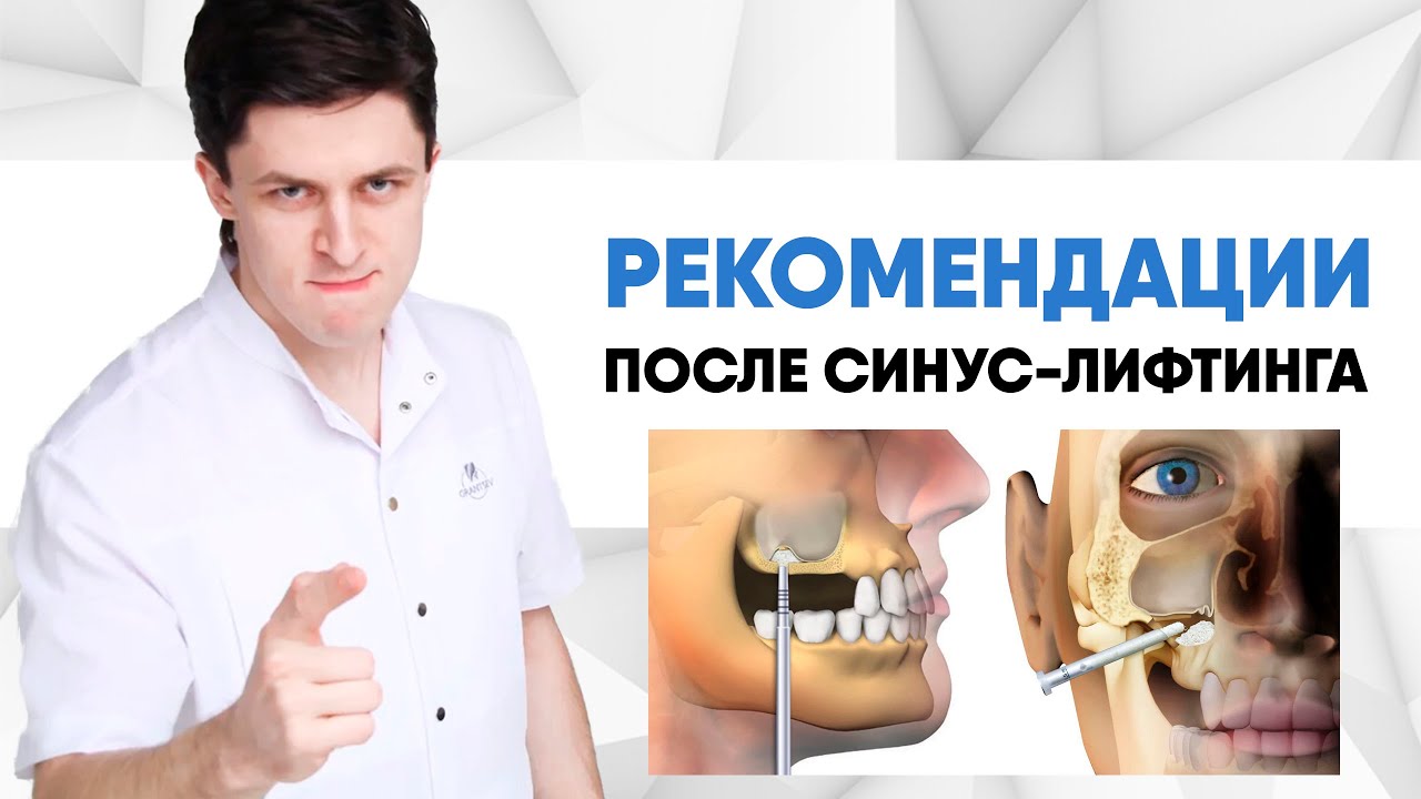Рекомендации после операции синус-лифтинг (Sinus-lift) [ открытый и закрытый синус-лифтинг ].
