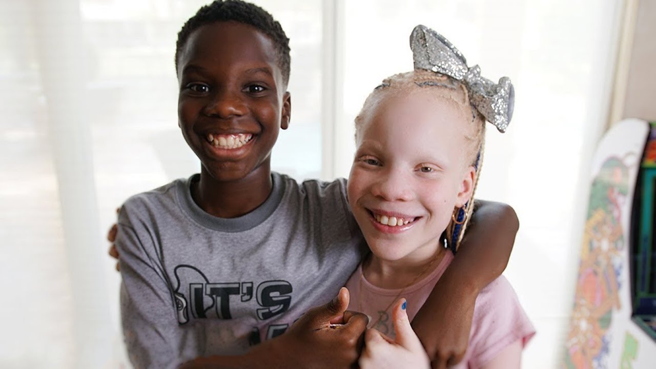 Unusual Twins Who Are One in A Million