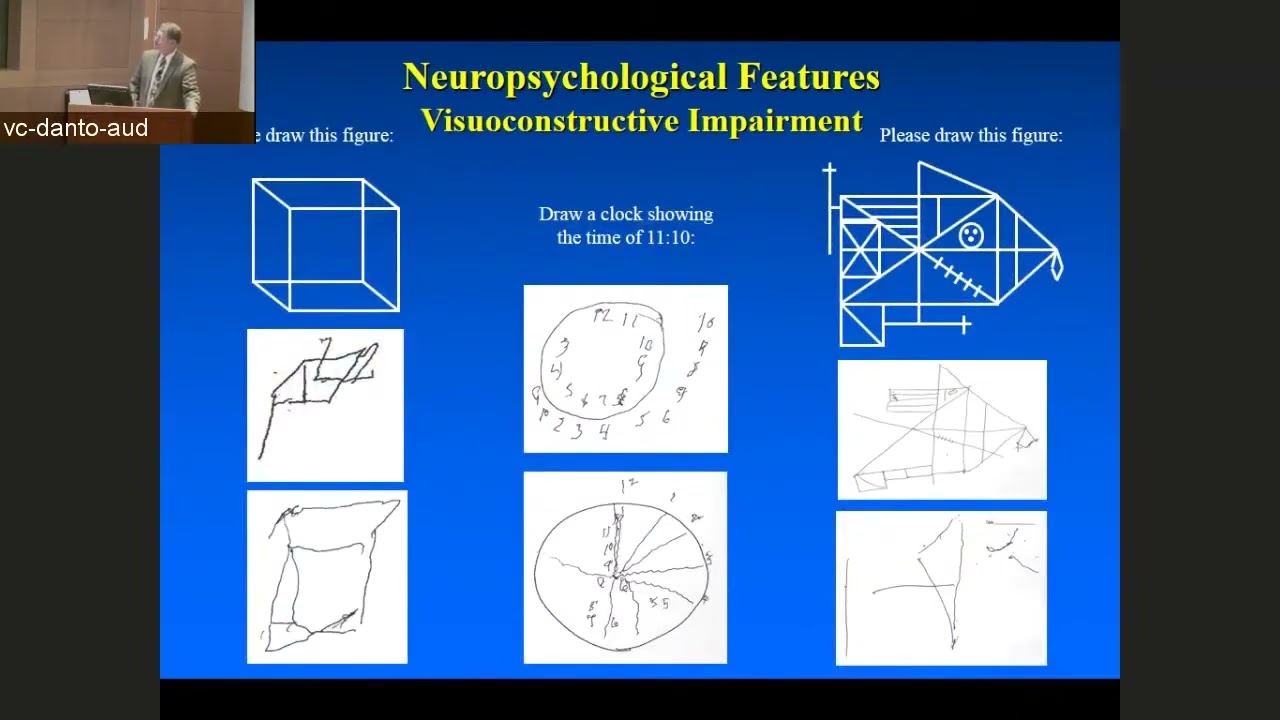 Lewy Body Dementia Update  Diagnosis, Management, and Future Directions