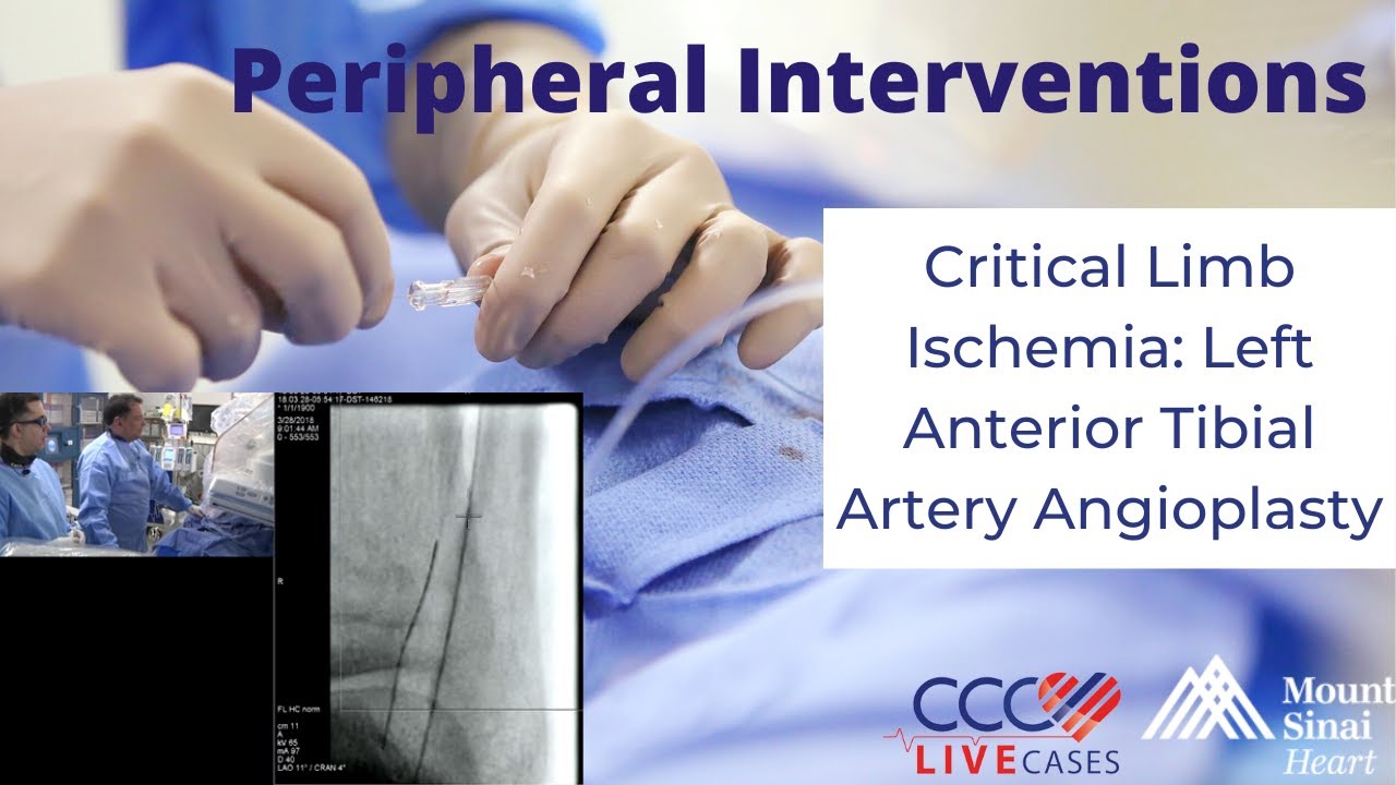 Critical Limb Ischemia: Left Anterior Tibial Artery Angioplasty - March 28, 2018