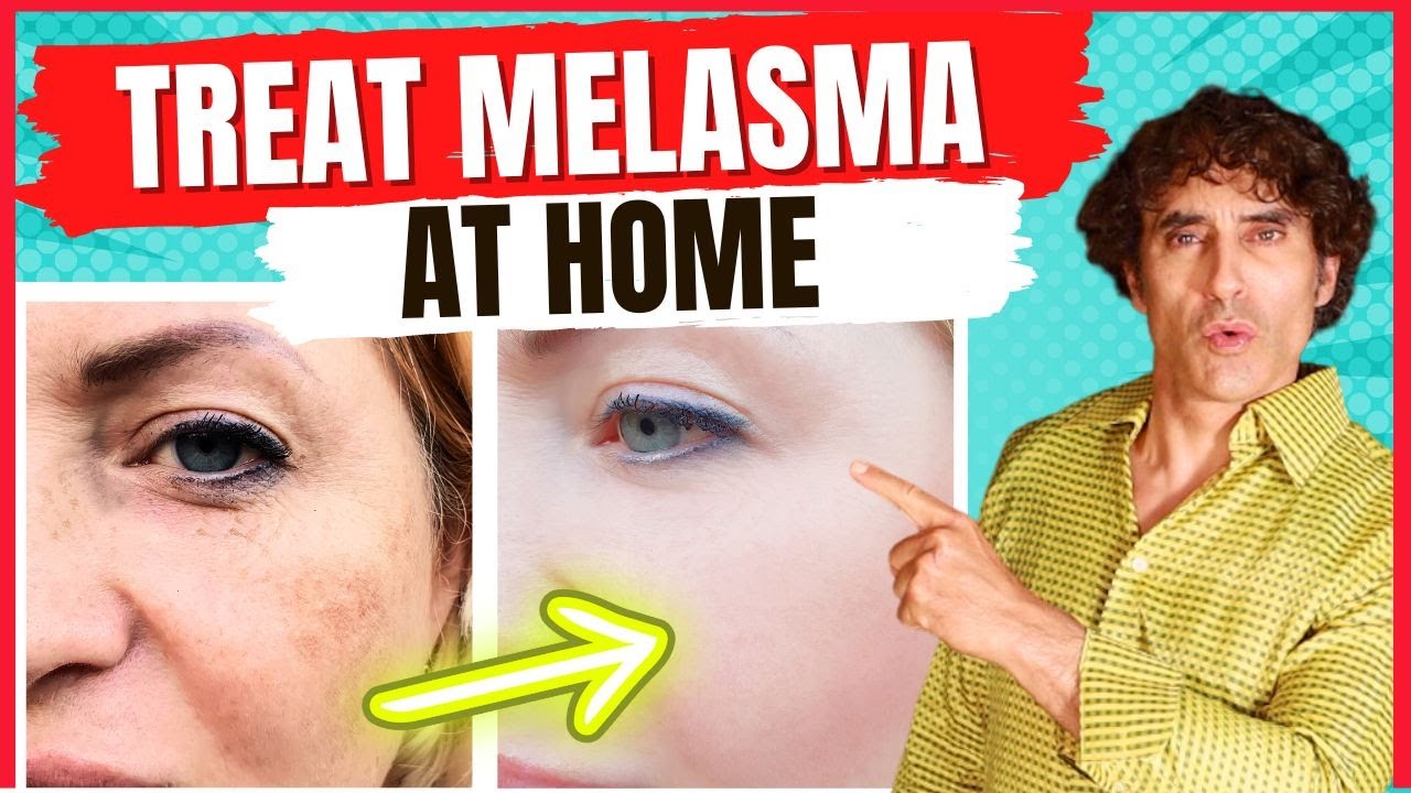 How to Treat MELASMA - Treat DARK SPOTS & PATCHES on The SKIN
