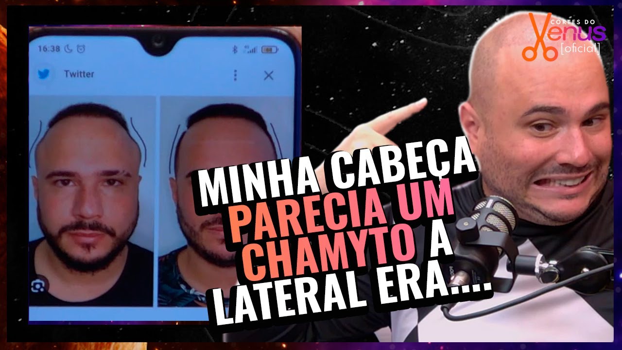 FIZ uma CIRURGIA de REDUÇÃO de CABEÇA!