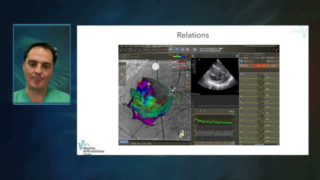 Presentation & Discussion: Intracardiac Ultrasound in VT Management