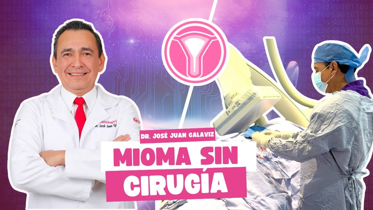 Embolización de Miomas: Todo lo que necesitas saber.