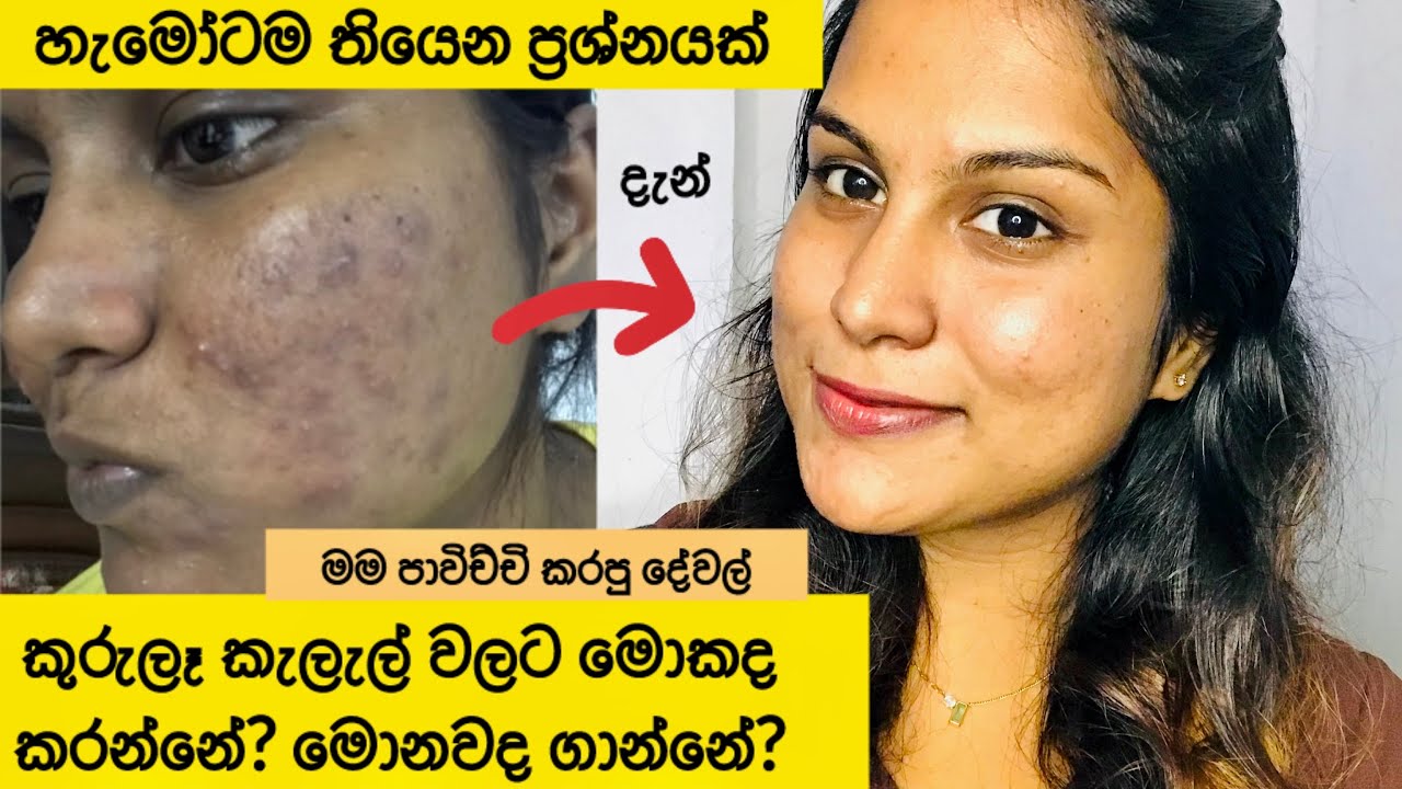 කුරුලෑ කැලැල් වලට පාවිච්චි කරන්න පුලුවන් දේවල් | pimple marks | product review | #vlog #skincare