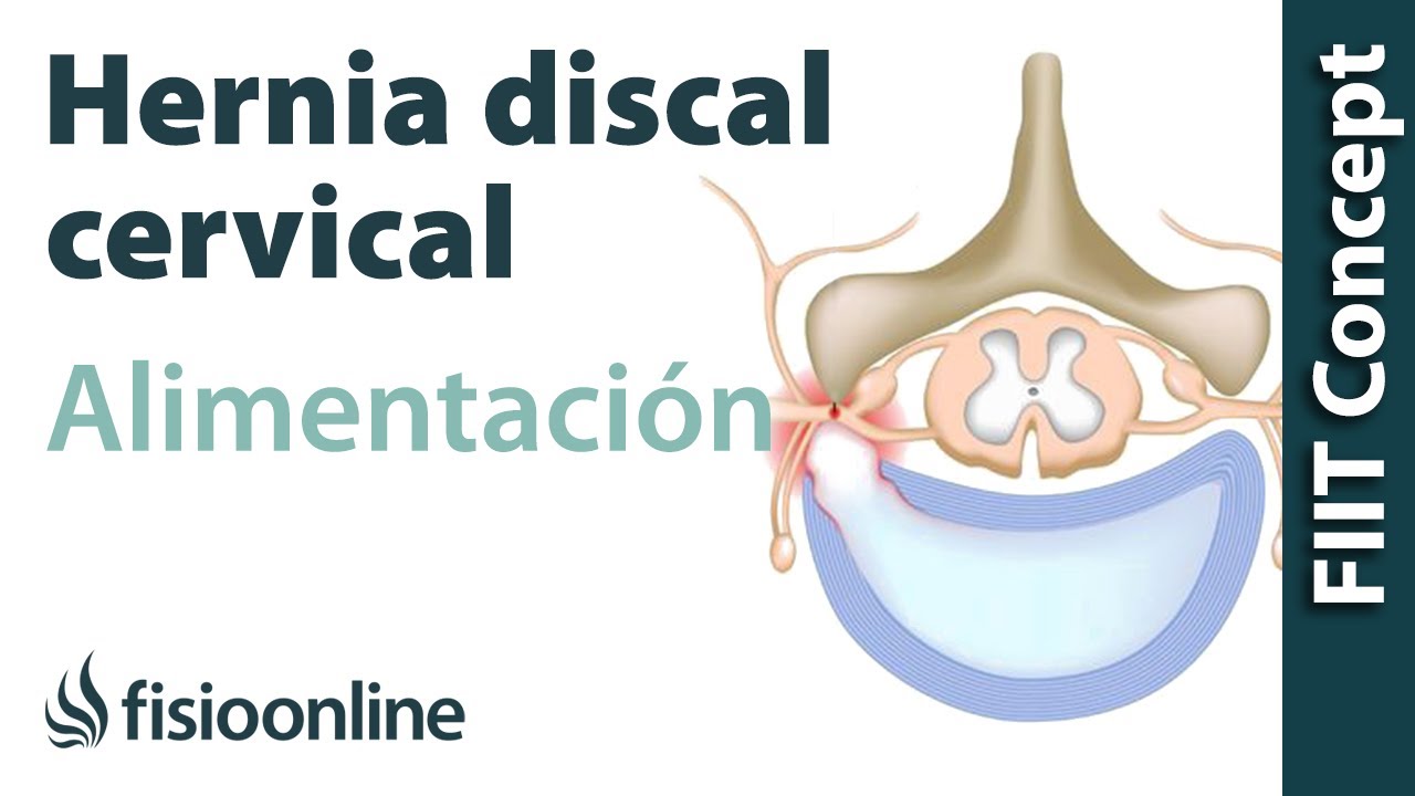 Hernia discal cervical Izquierda. Alimentación nutrición y modificaciones en la dieta