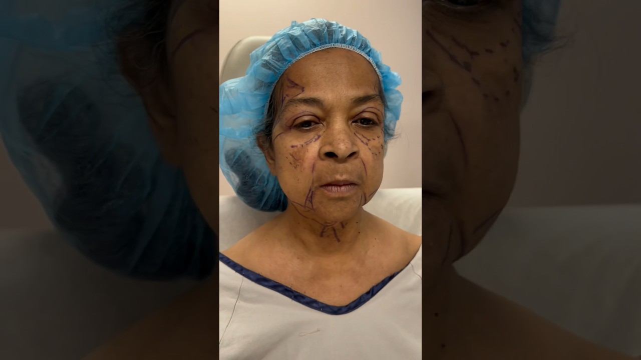 Insane Facelift Result! Plastic Surgery Done Right!