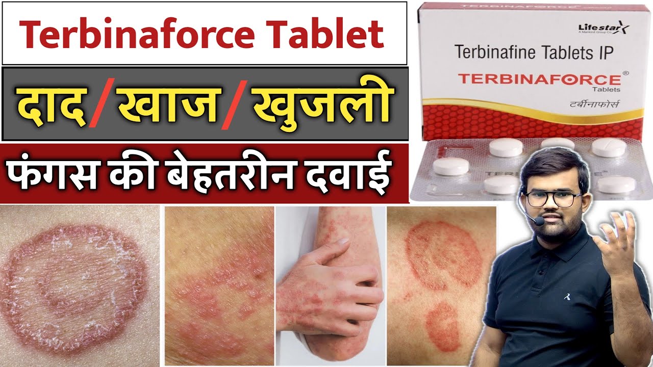 दाद, खाज, खुजली | Terbinaforce Tablet | Fungal Infection | Fungal Treatment | Medicine | Treatment