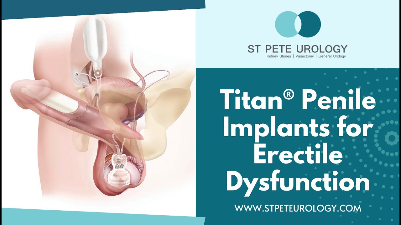 Titan® Penile Implants for Erectile Dysfunction