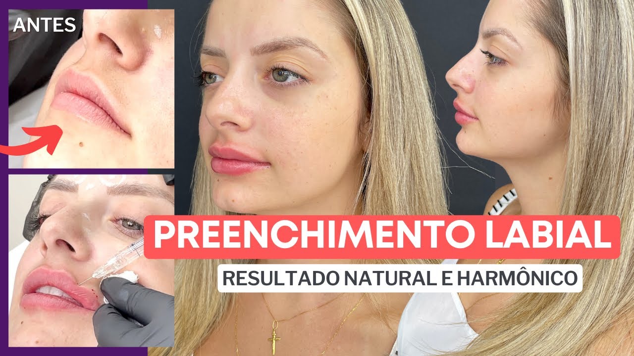 APLICAÇÃO DE PREENCHIMENTO LABIAL COM RESTYLANE KYSSE