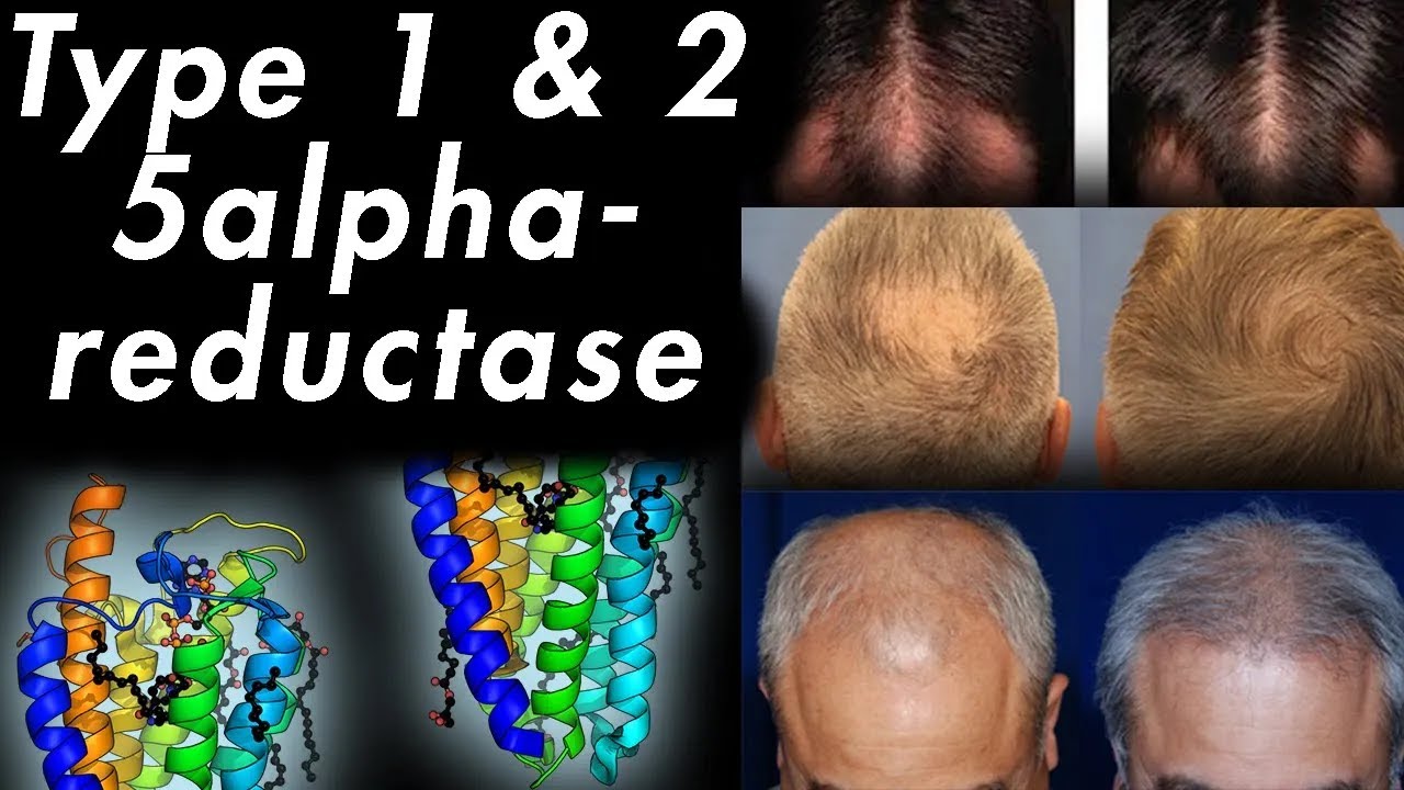 Nuking Scalp DHT with Dutasteride