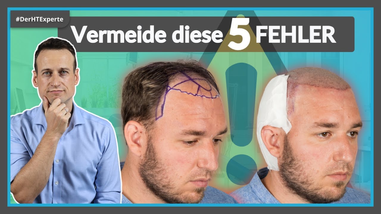Die 5 größten Fehler NACH einer Haartransplantation - auf das richtige VERHALTEN danach kommt es an