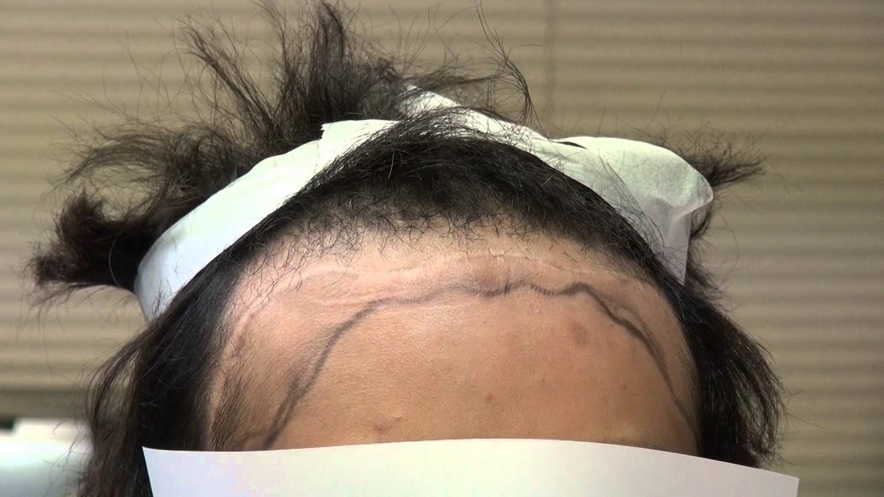 Transgender Woman Hairline Hair Transplant Feminine Surgery Dr. Diep www.mhtaclinic.com