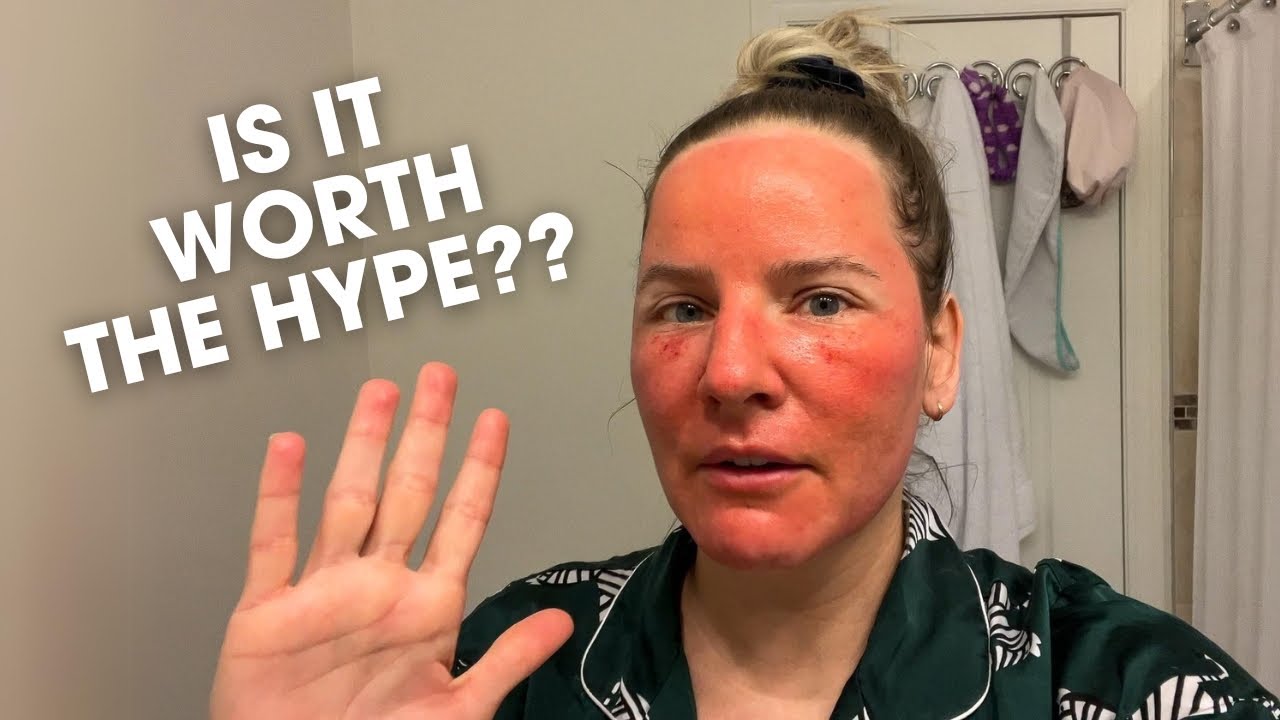 My CO2 Laser Recovery + Aftercare & Results